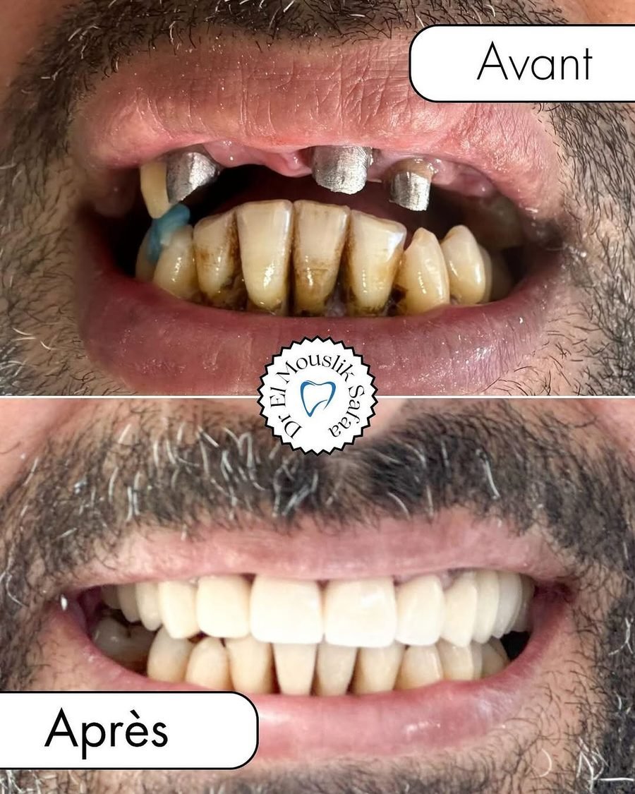 Résultat avant et après réalisé au Centre Dentaire NEW SMILE